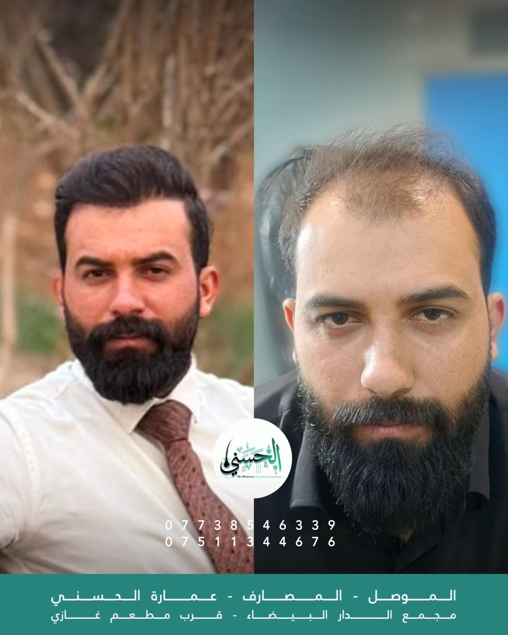 نتيجة زراعة الشعر قبل وبعد — عيادة الحسني الموصل — 02