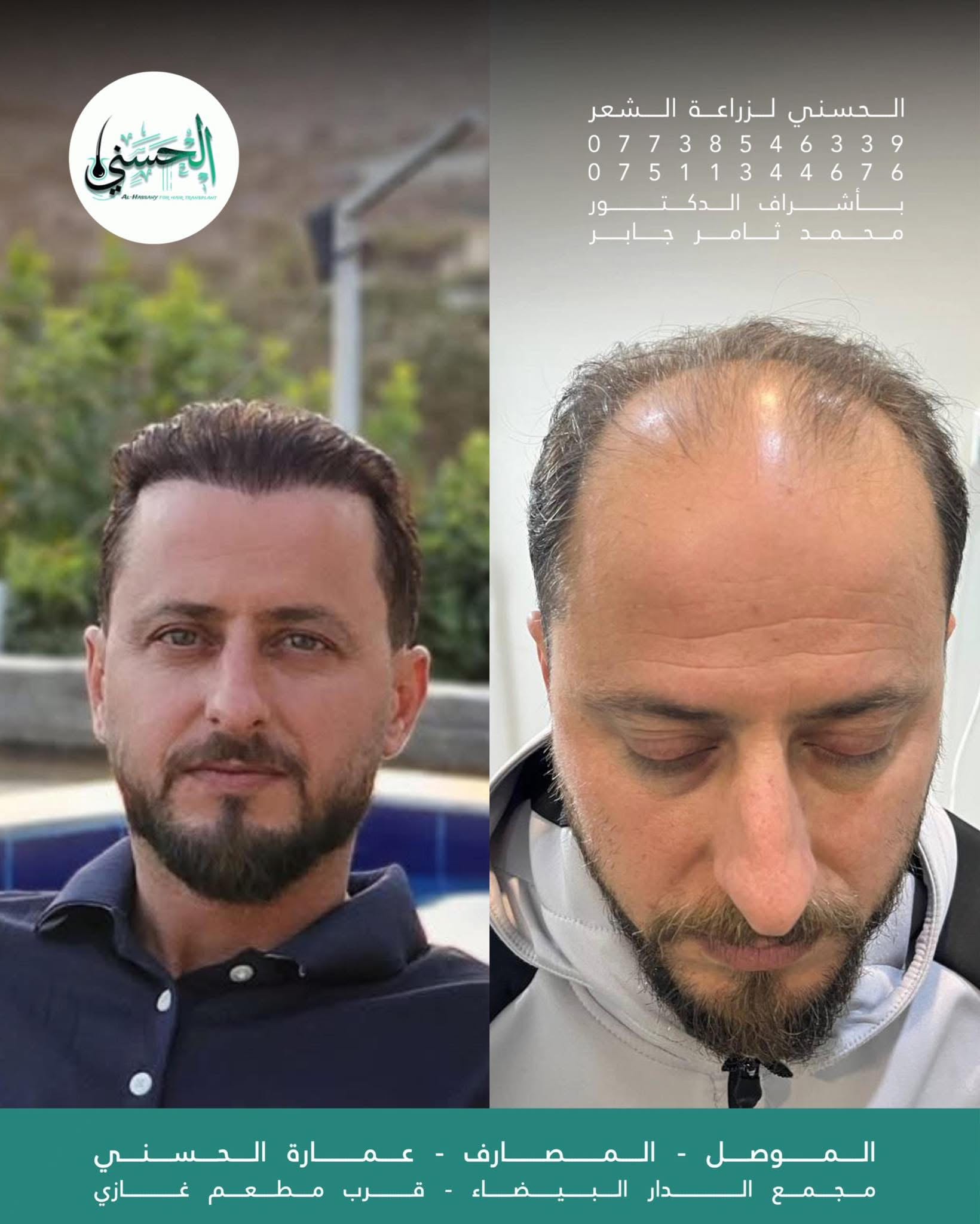 نتيجة زراعة الشعر قبل وبعد — عيادة الحسني الموصل — 07