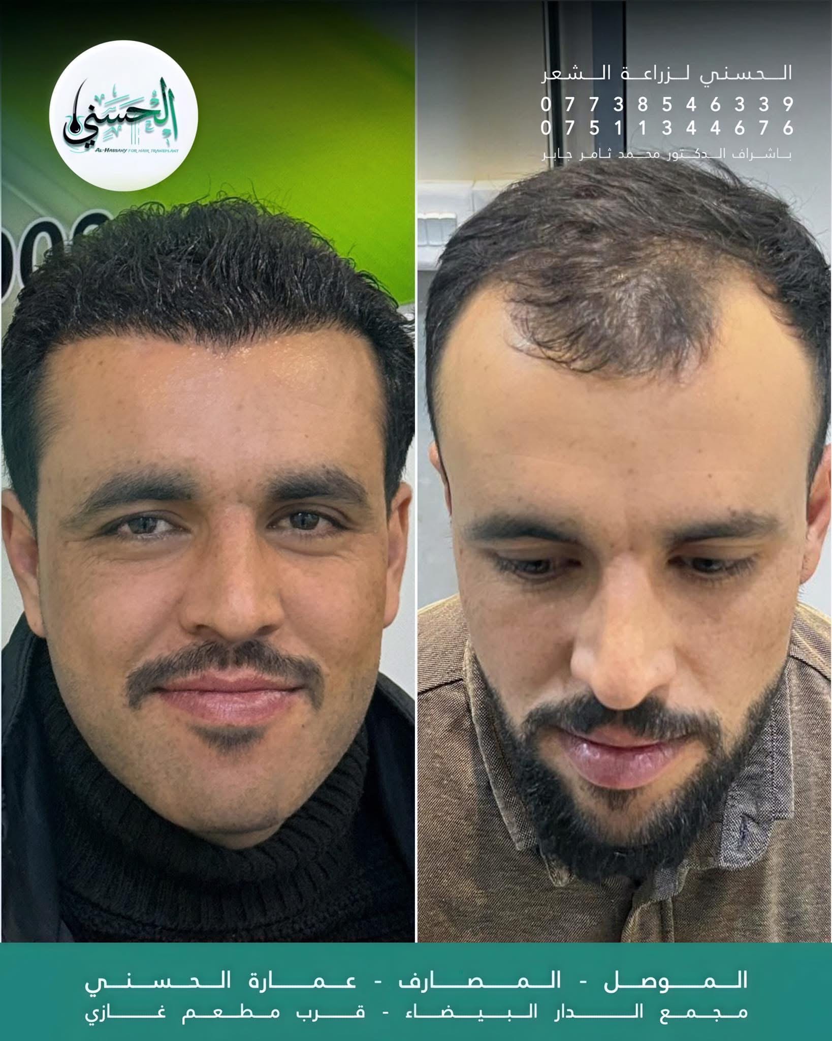 نتيجة زراعة الشعر قبل وبعد — عيادة الحسني الموصل — 10