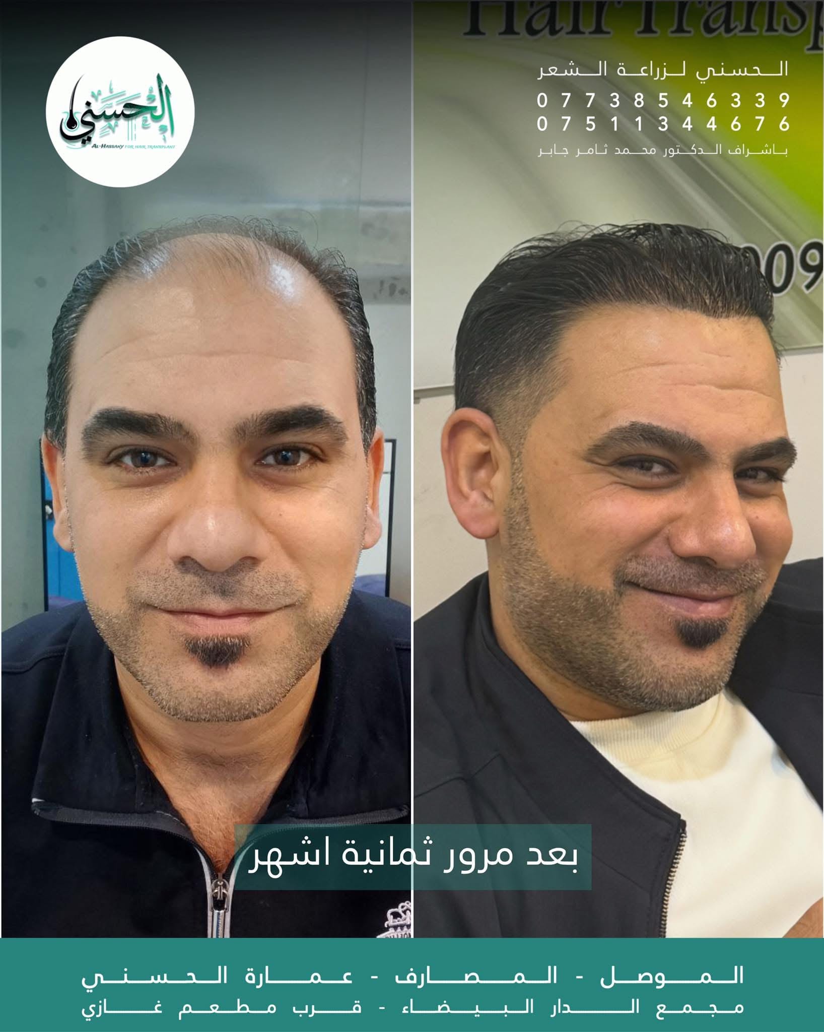نتيجة زراعة الشعر قبل وبعد — عيادة الحسني الموصل — 12