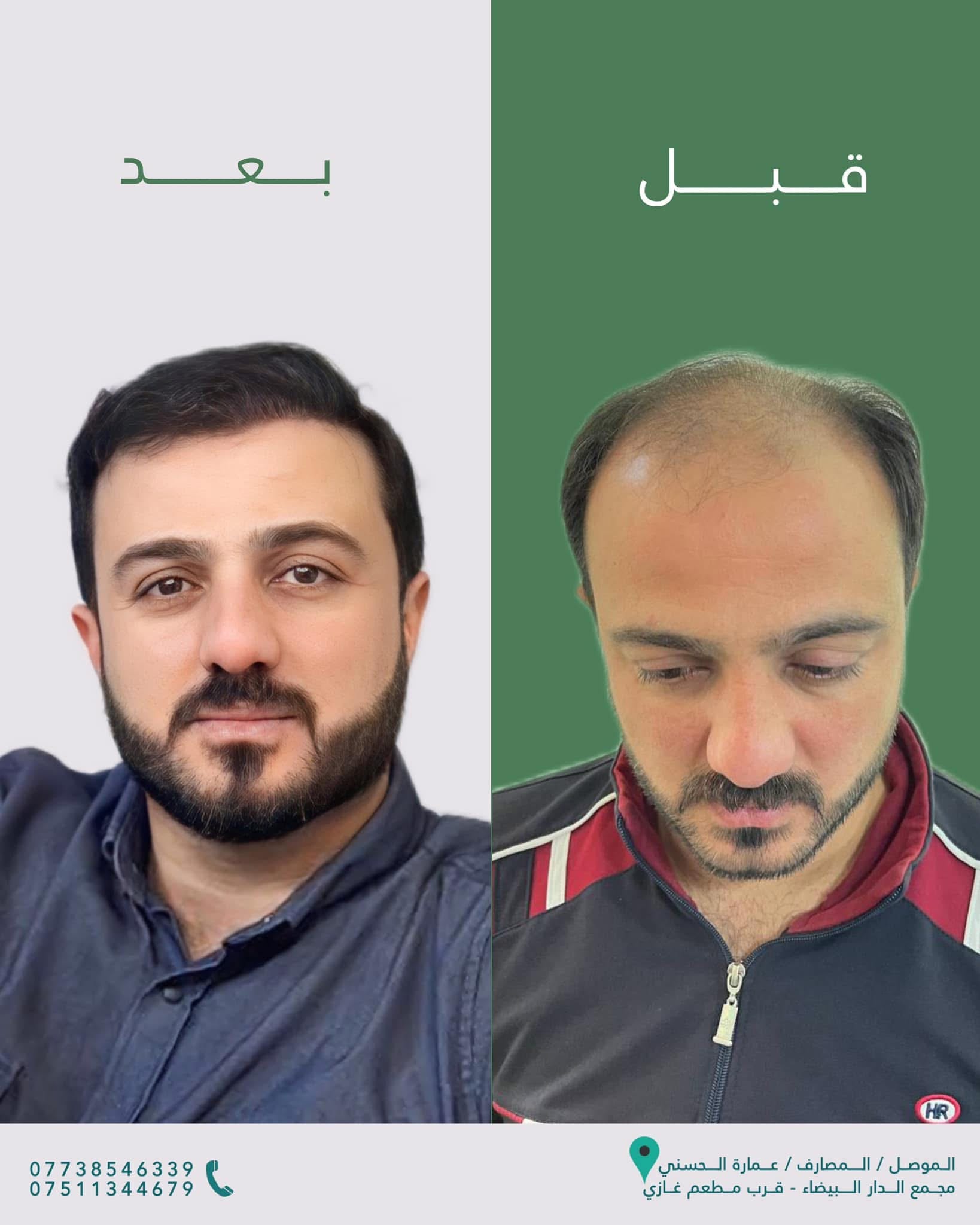 نتيجة زراعة الشعر قبل وبعد — عيادة الحسني الموصل — 14
